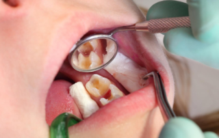 Preventing Tooth Decay in Children