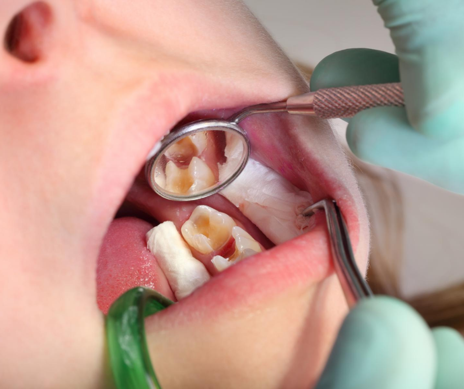 Preventing Tooth Decay in Children