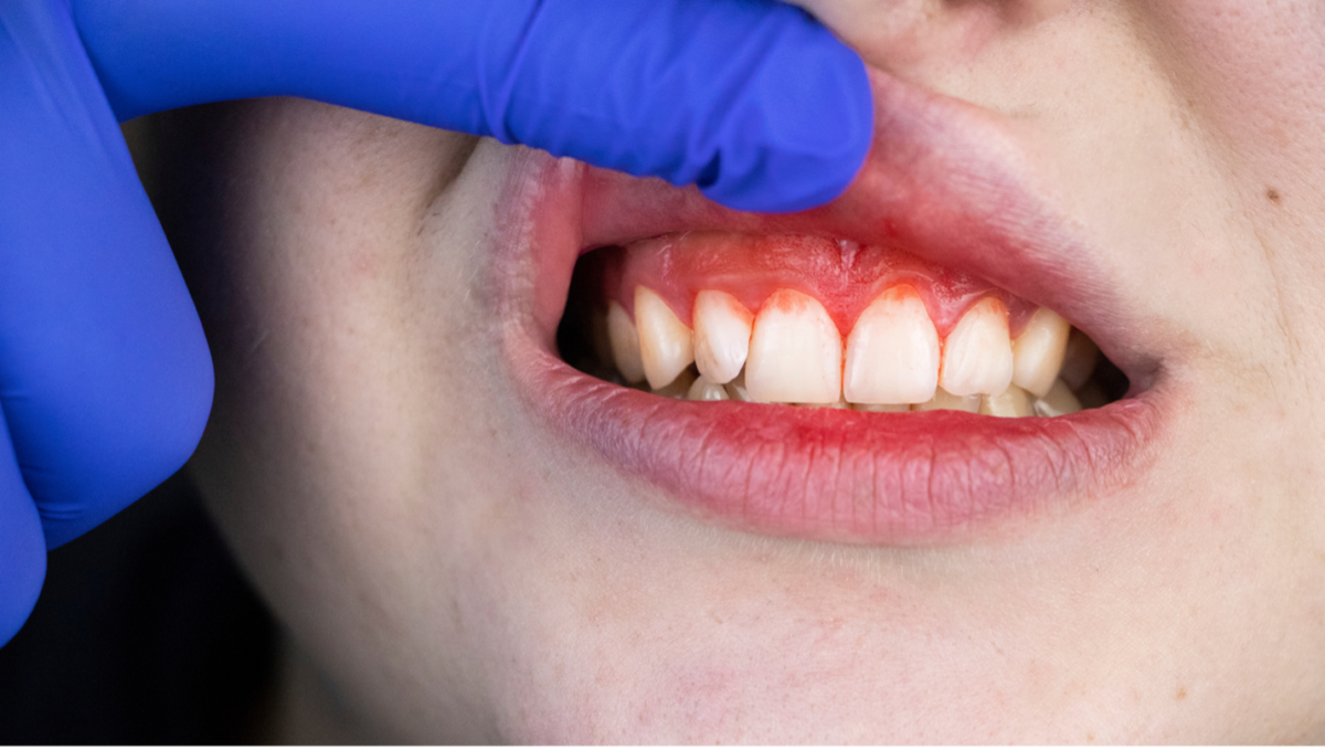 Gum Disease in Children Shoal Creek Smiles best pediatric dentist in