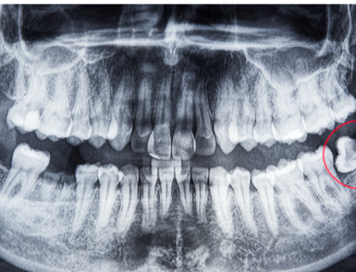 A Top Pediatric Dentist in Kearney, MO Explains Dental X-Rays