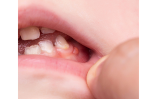 Emergency Pediatric Dentist in Kansas City