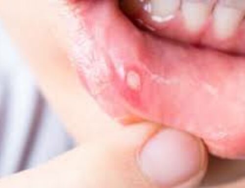 When to See Pediatric Dental Specialists in Kearney for Canker Sores